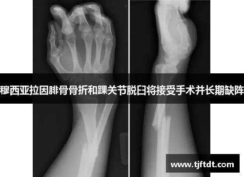 穆西亚拉因腓骨骨折和踝关节脱臼将接受手术并长期缺阵